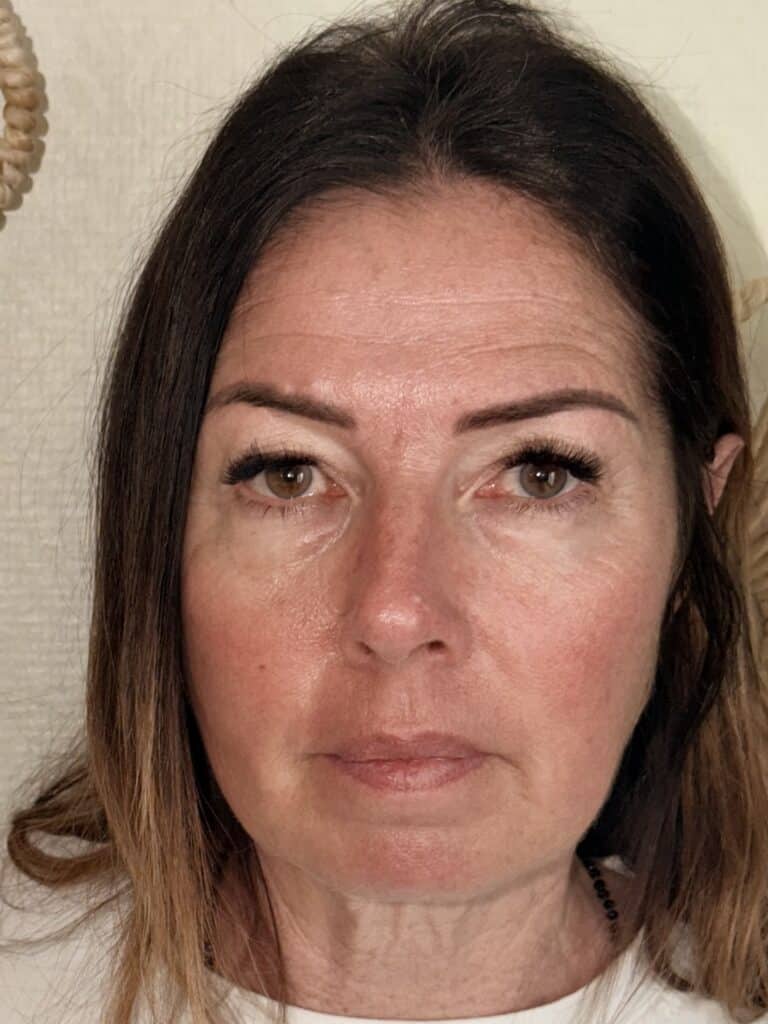 Soin-plasma-froid-anti-age-apres-toulouse Visage après le soin anti-âge au plasma froid : peau plus lisse et regard reposé – Soulef Esthétique Toulouse